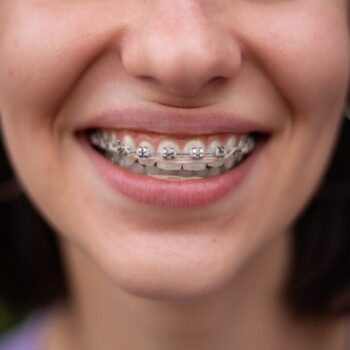 Ouders betalen voor beugel in 2026 minstens duizend euro, ondanks verzekering